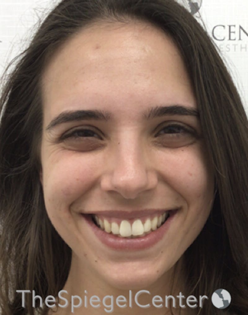 Botox / Dysport / Jeuveau / Xeomin Before & After Gallery - Patient 193912871 - Image 3
