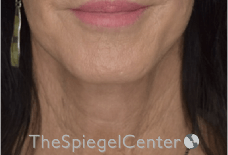 Neck Lift Before & After Gallery - Patient 193912899 - Image 4
