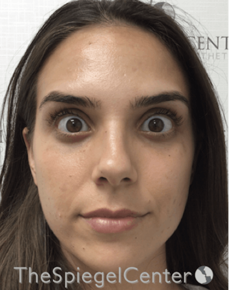 Botox / Dysport / Jeuveau / Xeomin Before & After Gallery - Patient 193912871 - Image 2
