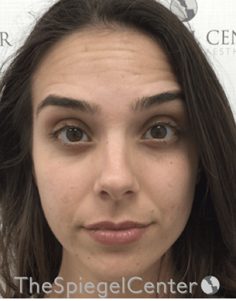 Botox / Dysport / Jeuveau / Xeomin Before & After Gallery - Patient 193912871 - Image 1