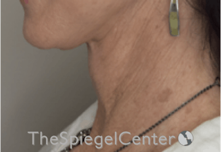 Neck Lift Before & After Gallery - Patient 193912899 - Image 2