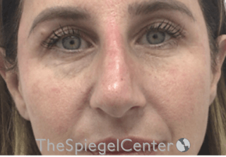 Non-Surgical Rhinoplasty / Nose Filler Before & After Gallery - Patient 196294576 - Image 2