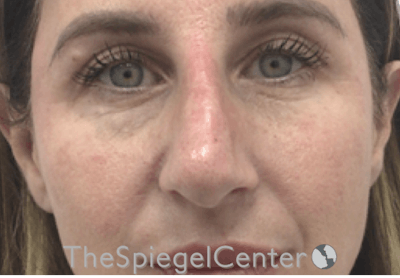 Non-Surgical Rhinoplasty / Nose Filler Before & After Gallery - Patient 196294576 - Image 2