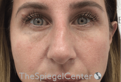 Non-Surgical Rhinoplasty / Nose Filler Before & After Gallery - Patient 196294576 - Image 1