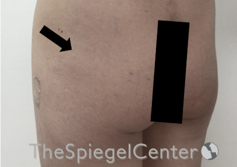 Liquid Butt Lift Before & After Gallery - Patient 196294568 - Image 3