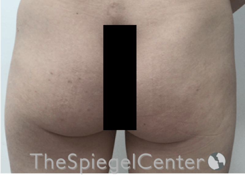 Liquid Butt Lift Before & After Gallery - Patient 196294568 - Image 1