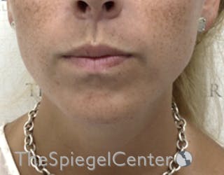 Neck Lipo Before & After Gallery - Patient 196294564 - Image 2
