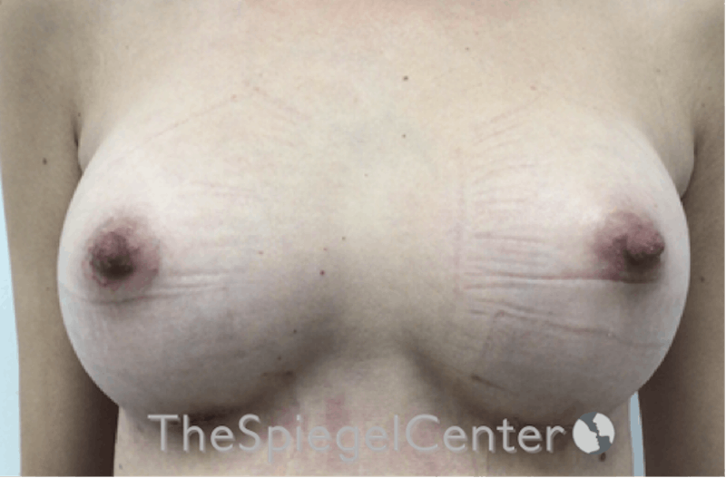 Breast Augmentation Before & After Gallery - Patient 198645869 - Image 2