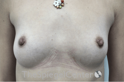 Breast Augmentation Before & After Gallery - Patient 198645869 - Image 1