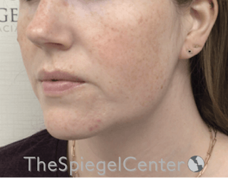 Masseter Botox Before & After Gallery - Patient 198645868 - Image 4