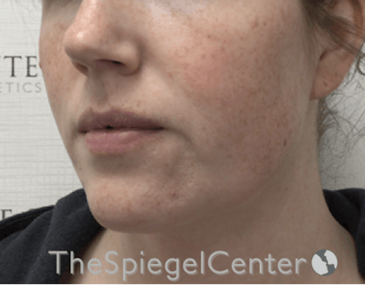 Masseter Botox Before & After Gallery - Patient 198645868 - Image 3