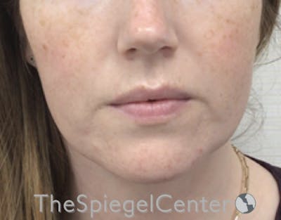 Masseter Botox Before & After Gallery - Patient 198645868 - Image 2