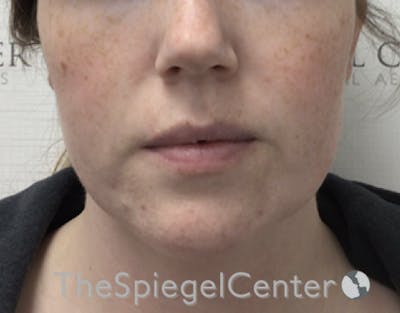 Masseter Botox Before & After Gallery - Patient 198645868 - Image 1