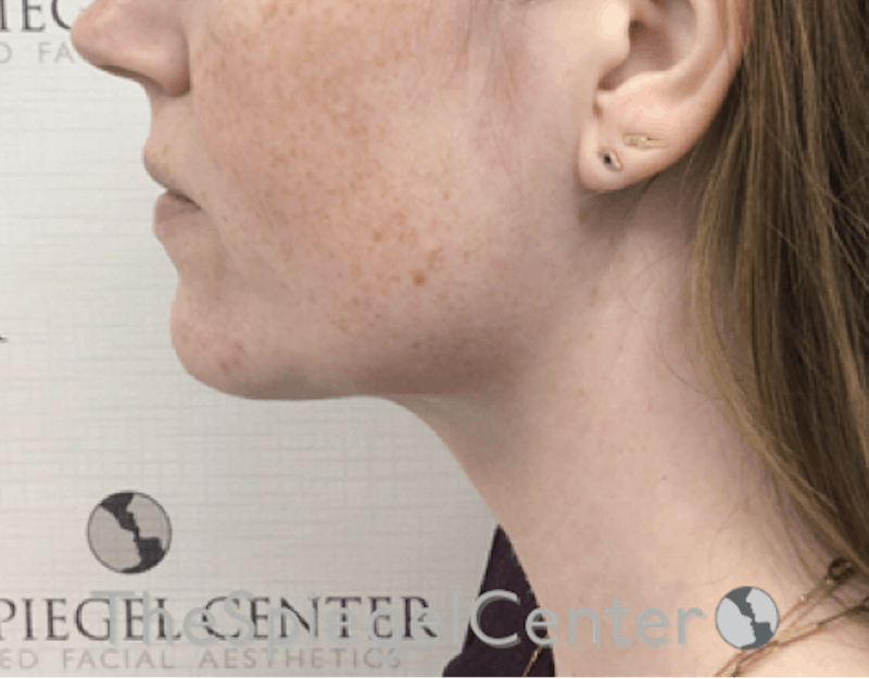 Facetite / Necktite / Embrace / Accutite Before & After Gallery - Patient 198645865 - Image 4