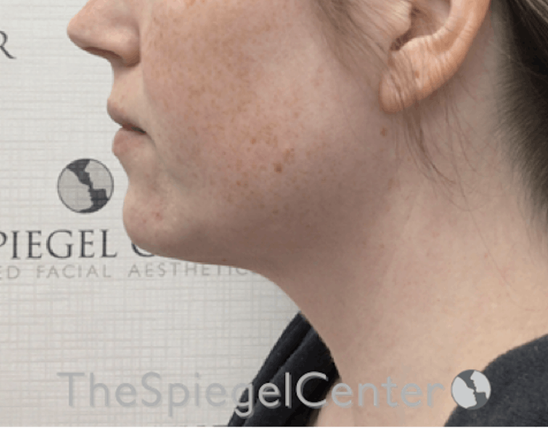 Facetite / Necktite / Embrace / Accutite Before & After Gallery - Patient 198645865 - Image 3