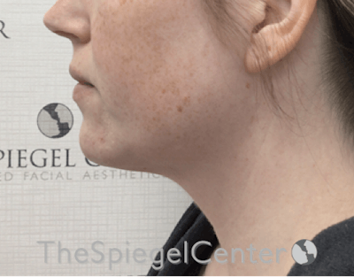 Facetite / Necktite / Embrace / Accutite Before & After Gallery - Patient 198645865 - Image 3