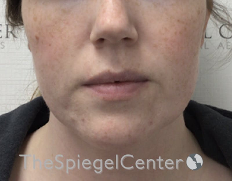 Facetite / Necktite / Embrace / Accutite Before & After Gallery - Patient 198645865 - Image 1