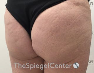 Liquid Butt Lift Before & After Gallery - Patient 198645864 - Image 4