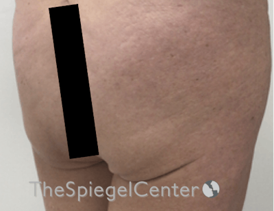 Liquid Butt Lift Before & After Gallery - Patient 198645864 - Image 3