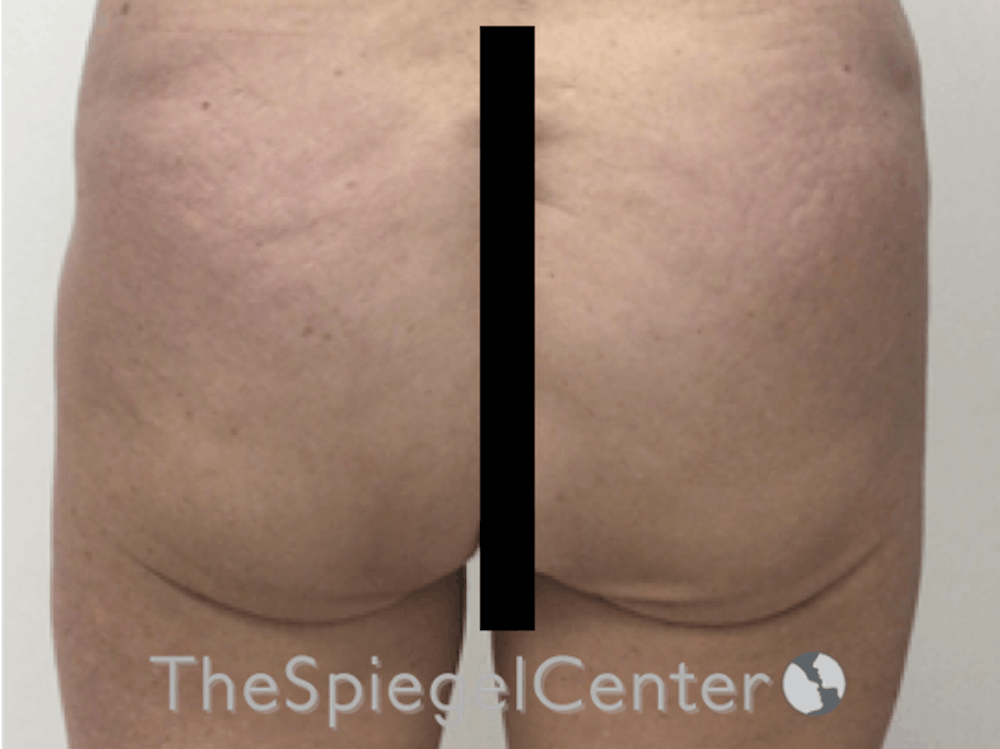 Non-Surgical Butt Lift
