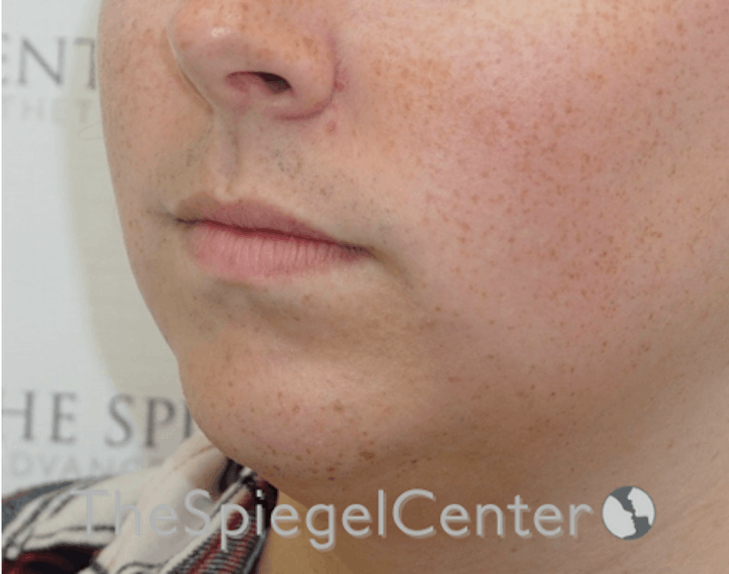 Lip Augmentation / Lip Implant / Lip Lift Before & After Gallery - Patient 199550741 - Image 3