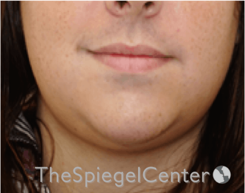 Lip Lift Before & After Gallery - Patient 199550741 - Image 1