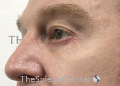 Blepharoplasty Before & After Gallery - Patient 199550738 - Image 4