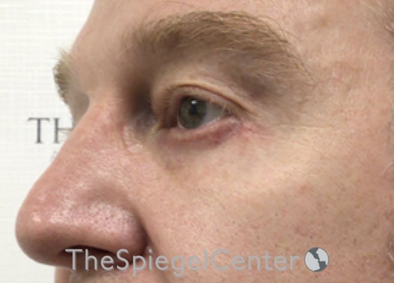 Blepharoplasty Before & After Gallery - Patient 199550738 - Image 4