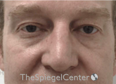 Blepharoplasty Before & After Gallery - Patient 199550738 - Image 1