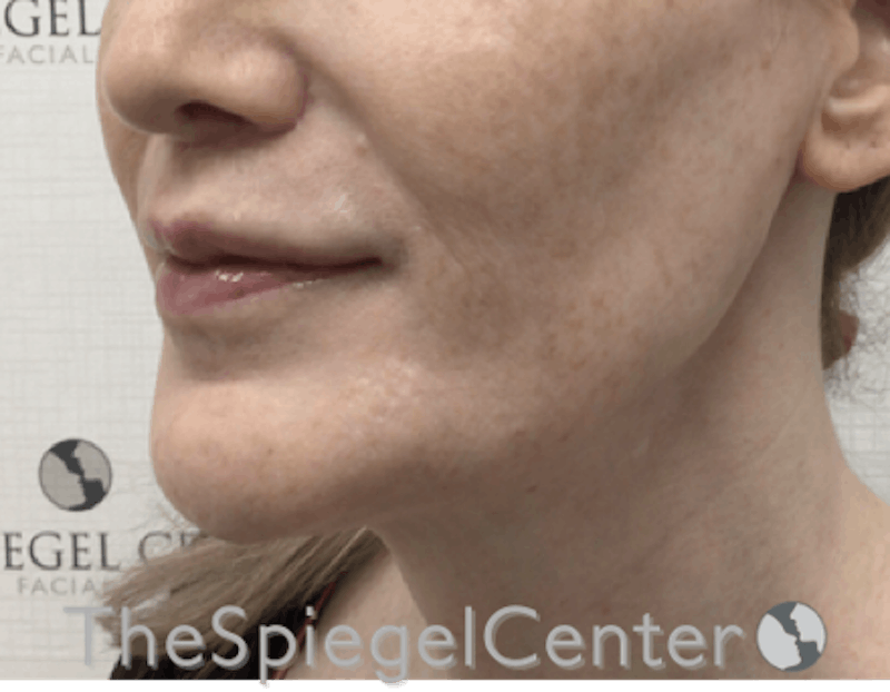 Lip Filler Before & After Gallery - Patient 199550736 - Image 6