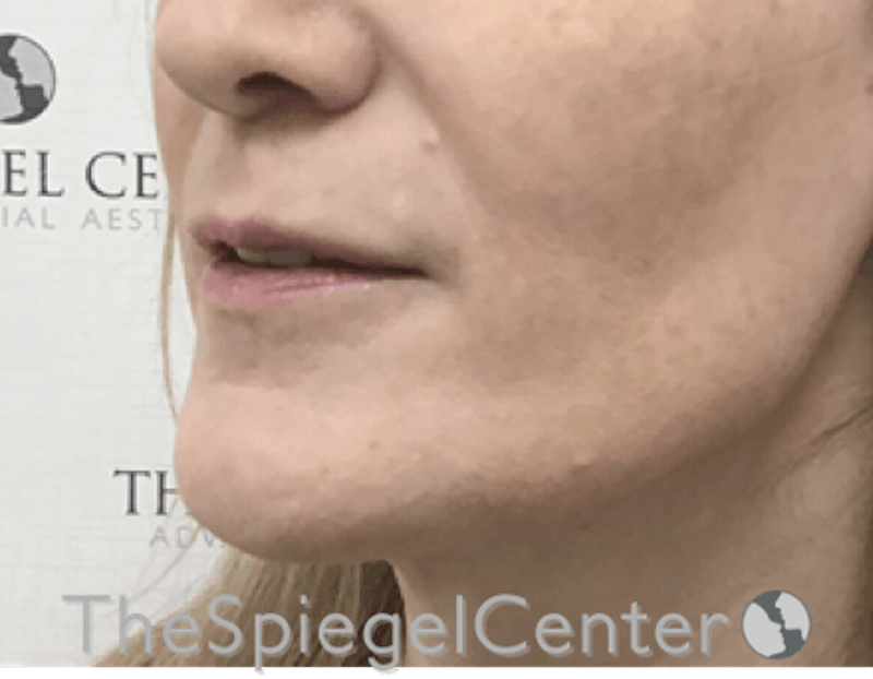 Lip Filler Before & After Gallery - Patient 199550736 - Image 5