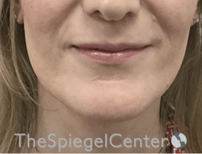 Lip Filler Before & After Gallery - Patient 199550736 - Image 3