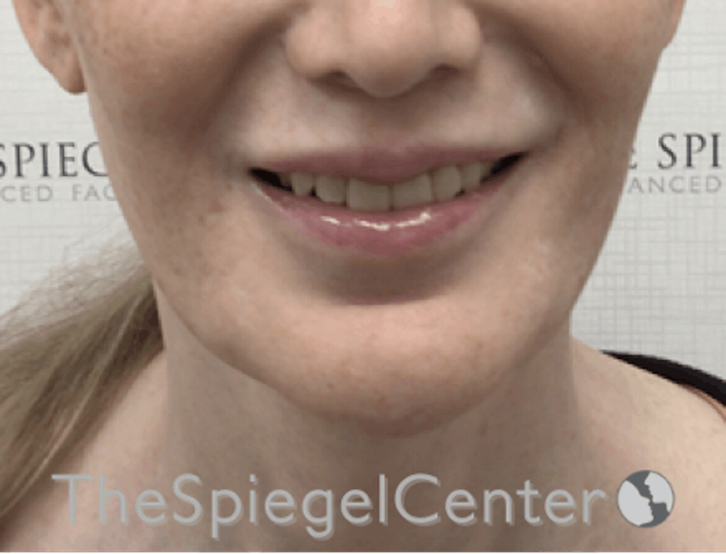 Lip Filler Before & After Gallery - Patient 199550736 - Image 2