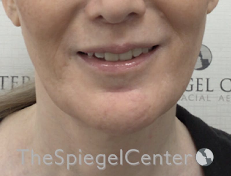 Lip Filler Before & After Gallery - Patient 199550736 - Image 1