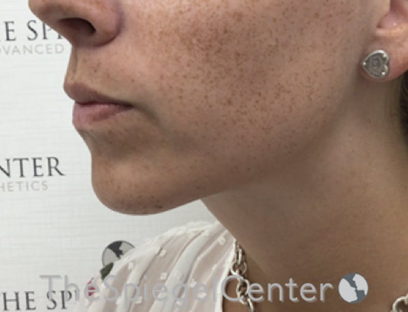 Mandible Contouring Before & After Gallery - Patient 299487 - Image 4