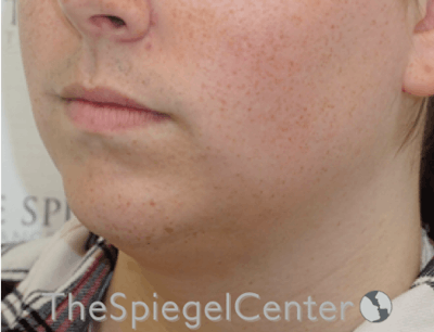 Mandible Contouring Before & After Gallery - Patient 299487 - Image 3