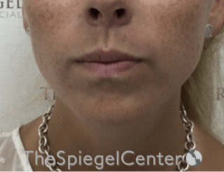 Mandible Contouring Before & After Gallery - Patient 299487 - Image 2