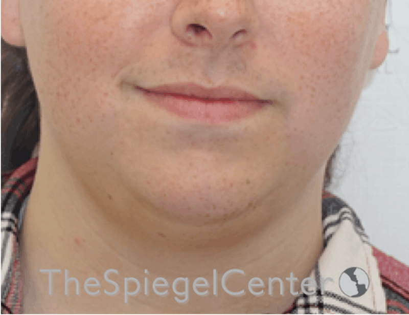 Mandible Contouring Before & After Gallery - Patient 299487 - Image 1