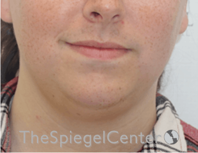 Mandible Contouring Before & After Gallery - Patient 299487 - Image 1