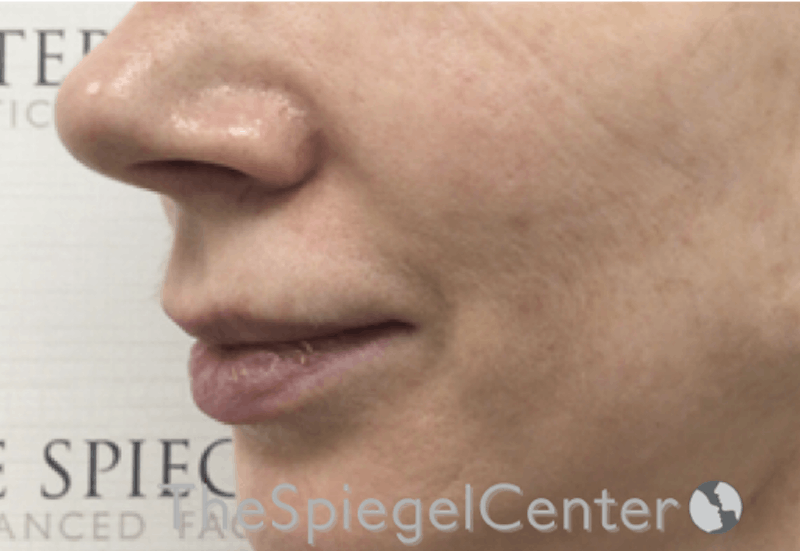 Nasolabial Fold Filler Before & After Gallery - Patient 385275 - Image 3