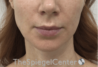 Nasolabial Fold Filler Before & After Gallery - Patient 385275 - Image 2