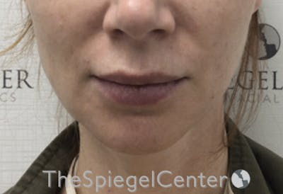 Nasolabial Fold Filler Before & After Gallery - Patient 385275 - Image 1