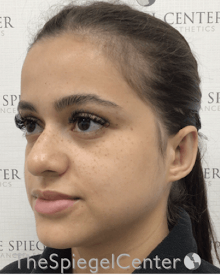 Ear Pinning / Otoplasty Before & After Gallery - Patient 332990 - Image 4