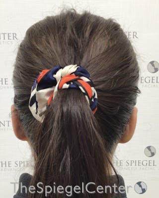 Ear Pinning / Otoplasty Before & After Gallery - Patient 332990 - Image 2