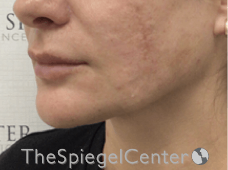 Mandible Contouring Before & After Gallery - Patient 421078 - Image 4