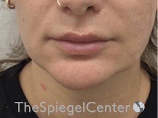 Mandible Contouring Before & After Gallery - Patient 421078 - Image 2
