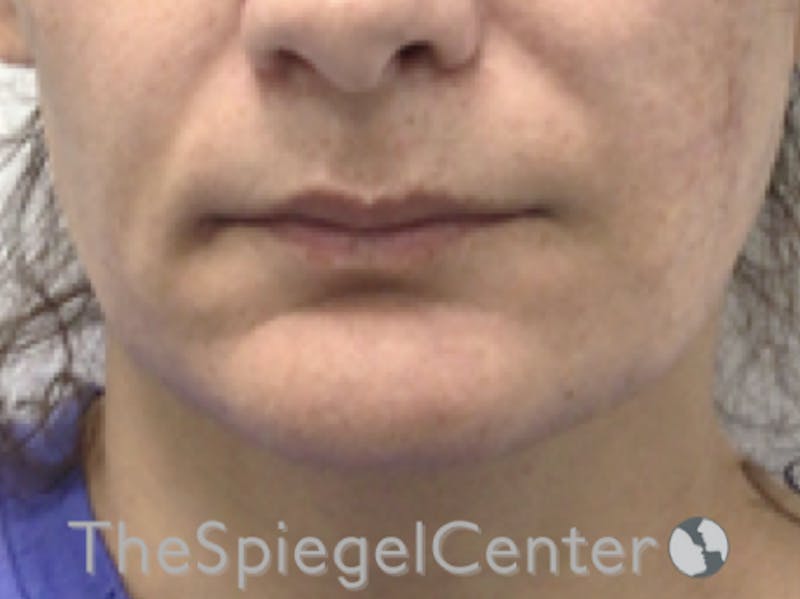 Mandible Contouring Before & After Gallery - Patient 421078 - Image 1