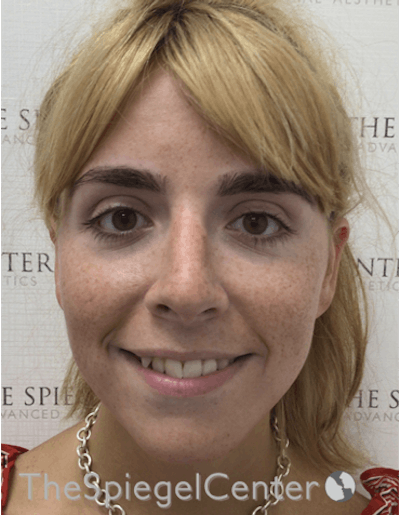 FFS Before & After Gallery - Patient 157140175 - Image 3