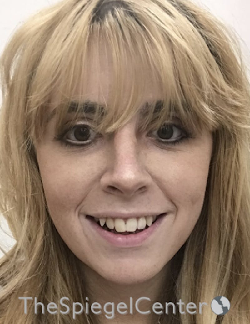 FFS Before & After Gallery - Patient 157140175 - Image 2