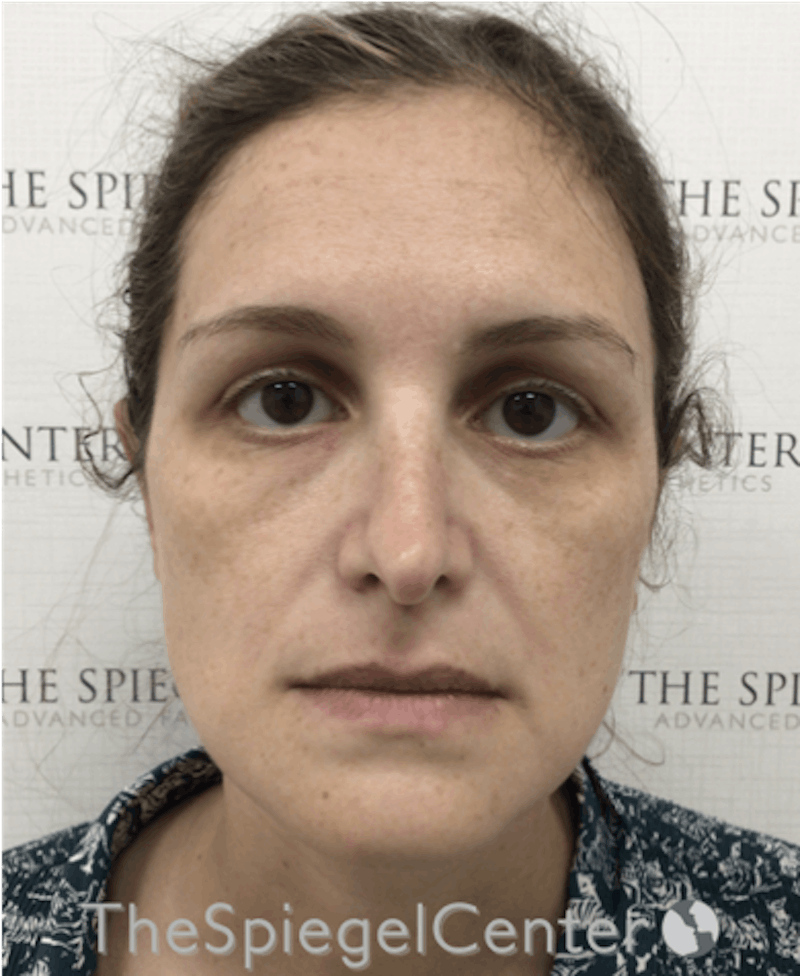 Ear Pinning / Otoplasty Before & After Gallery - Patient 138058 - Image 4